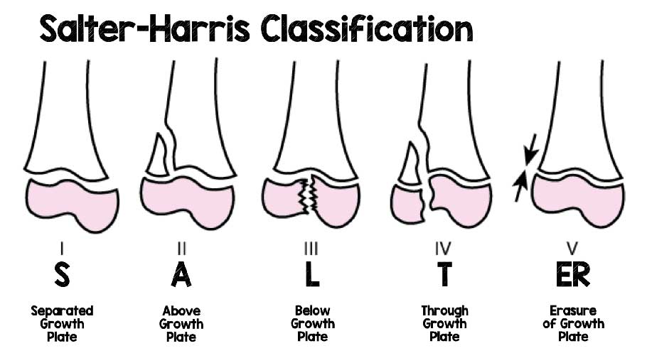 Classification fractures de Salter et Harris
